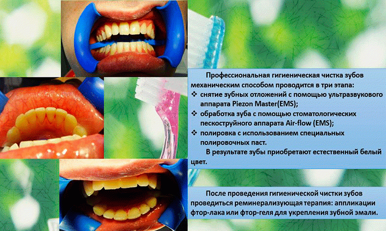 Этапы гигиены полости рта. Профессиональная гигиена полости рта. Методы проведения профессиональной гигиены полости рта. Гигиена полости рта этапы. Этапы профессиональной гигиены полости.