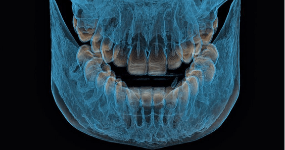 Компьютерная 3D томография челюсти